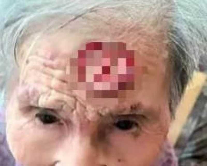 Close-up of an elderly woman’s forehead with a blurred red wound covered in pixelation.