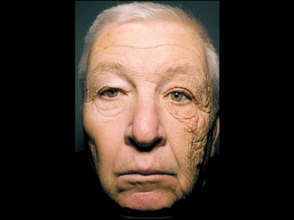 People who still look young in their 60s and beyond usually adopt these 8 daily habits 3 A 69-year-old man who drove a delivery truck for 28 years shows damaged skin on the left side of his face.